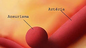 Aneurisma Cerebral