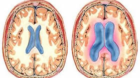 Hidrocefalia